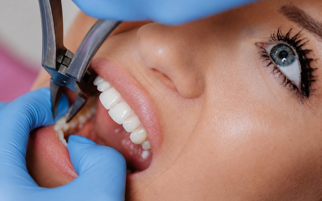 Tooth Extractions
